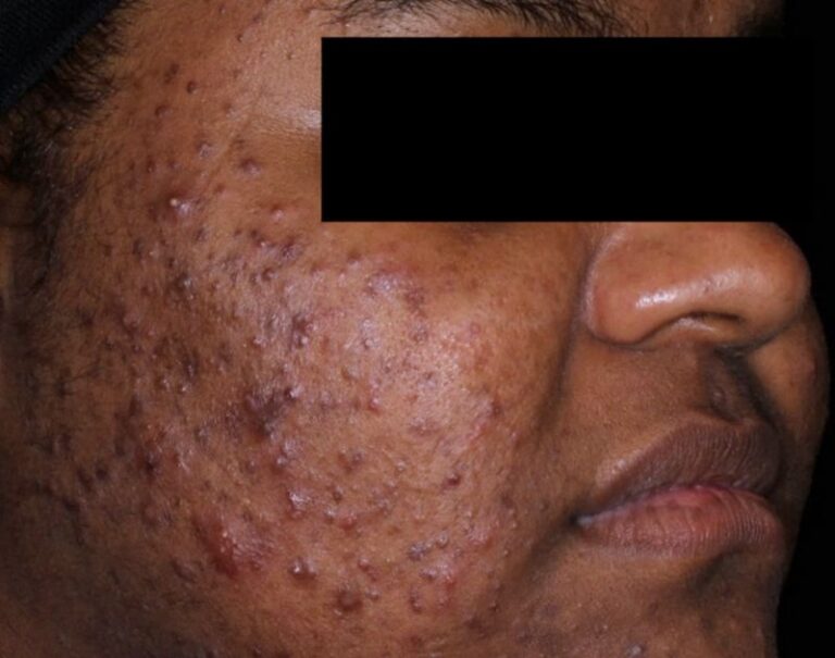 acne (2)